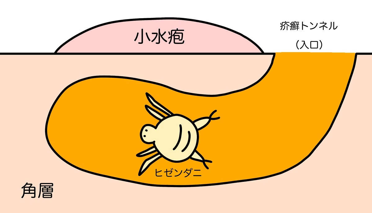 ヒゼンダニの駆除方法や疥癬（かいせん）について／ヒゼンダニはどこにいる？